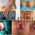 Penyakit Keluar Darah dari Lubang Dubur thumbnail