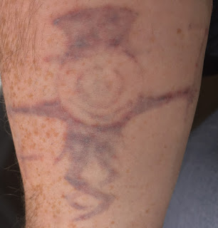 Laser tattoo removal Tattoo 24 hours after picosure tattoo removal