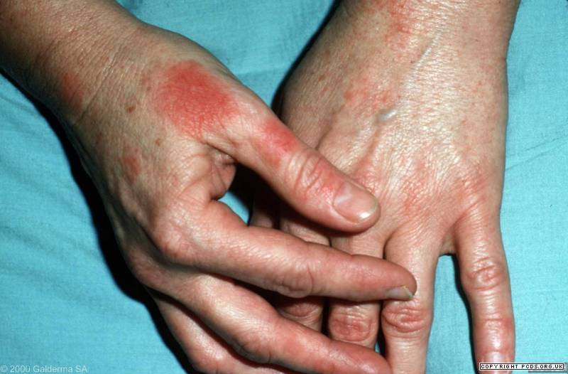 CDC - Contact Dermatitis and Latex Allergy - FAQs ...