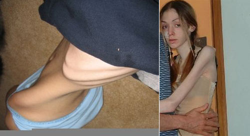 Nude Anorexic Women Photos 103