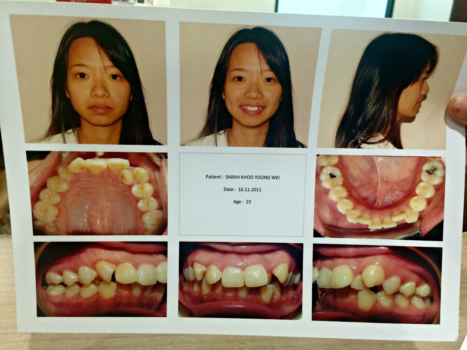 sarahkhooyw My Braces Story.