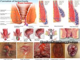 Tips Manjur Untuk Pengobatan Ambeien Tips Dan Cara Pengobatan Pada Ambeien