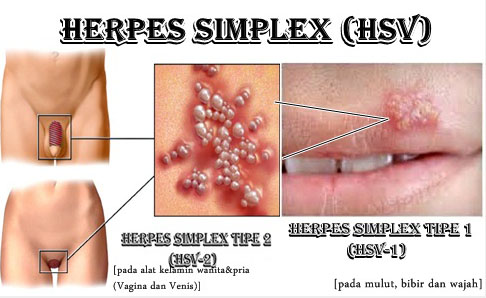 hpv herpes genitalis)