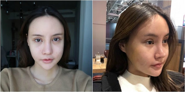 Sudah Habis Rp. 500 Juta untuk Oplas, Malah Menderita, Tapi Setelah 3 Bulan Hasilnya Bikin Melongo Sudah Habis Rp. 500 Juta untuk Oplas, Malah Menderita, Tapi Setelah 3 Bulan Hasilnya Bikin Melongo