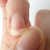 Ayurvedic Weak Nails Treatment by Ram Dev therapy