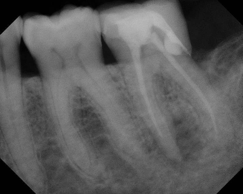 the-endo-blog-missed-canals-cause-root-canal-failure