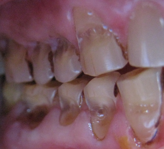 Academy of Dental Knowledge Abrasion Of Teeth and its Consequesces