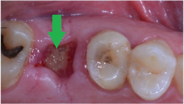 Cicatrizacion Exodoncia