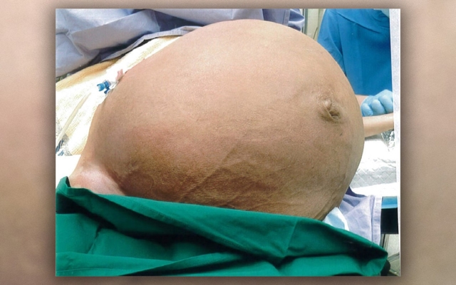 Le extirparon un tumor de 61 libras; ni la dejaba respirar Le extirparon un tumor de 61 libras; ni la dejaba respirar