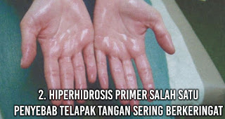 Hiperhidrosis Primer salah satu penyebab Telapak Tangan Sering Berkeringat
