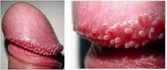 Pápulas-perladas-del-pene-tratamientos