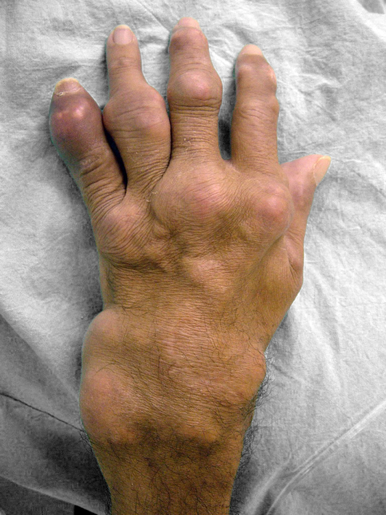 Clínica e Cirurgia do Pé e Tornozelo Gota e Artrite Reumatóide Clínica e Cirurgia do Pé e Tornozelo Gota e Artrite Reumatóide
