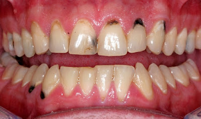 Răng sứ titan có bị đen sau phục hình?