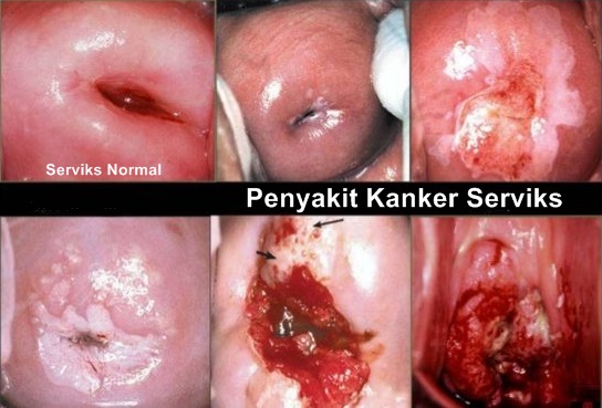 5 Cara Pencegahan Kanker Serviks Yang Perlu Anda Lakukan 5 Cara Pencegahan Kanker Serviks Yang Perlu Anda Lakukan