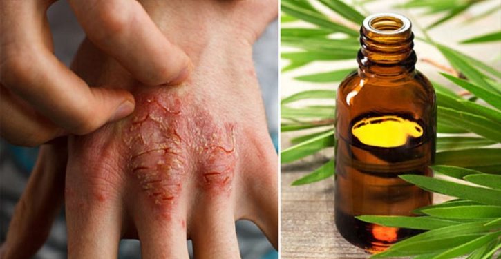 Here Is The Oil That Fights Acne, Eczema And Psoriasis Better Than Anything