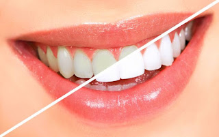 وصفات تبيض الاسنان - ويب طب بالصخة والهنا