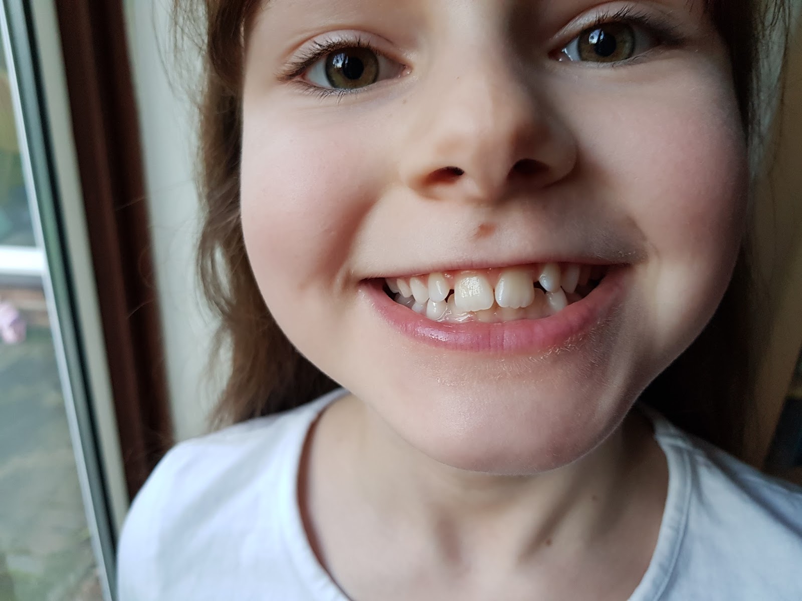 The Muminator Grey teeth after hitting mouth