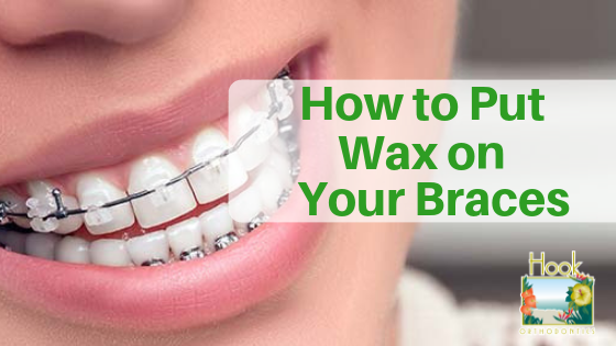 How to Put Wax on Your Braces?