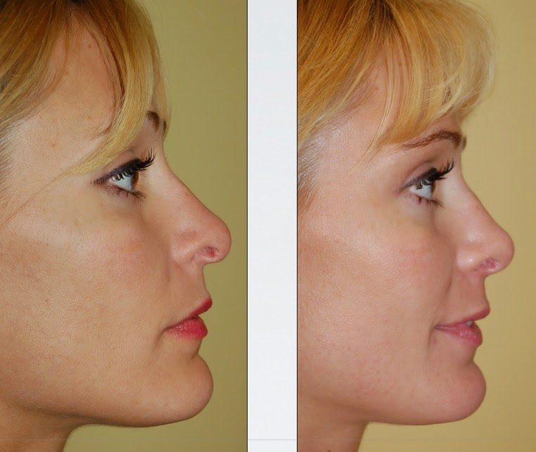 Perfect Nose Nose Straightener Review