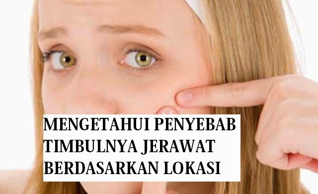 penyebab jerawat penyebab jerawat