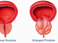 tumor Prostat stadium 2