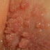 Obat Kutil Kelamin di Asmat thumbnail