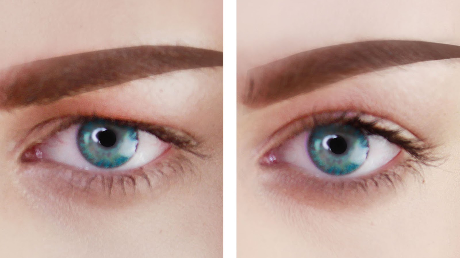 My Plastic Surgery Korea Korean Plastic Surgery for Dark Circles and