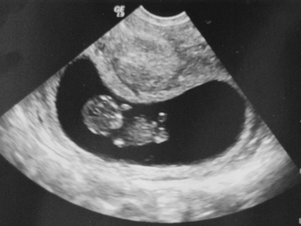 10 неделя 2024г. Эмбрион на 10 неделе беременности УЗИ. УЗИ 10 недель беременности. 10 Недель беременности по УЗИ. УЗИ 10 недель беременности фото.