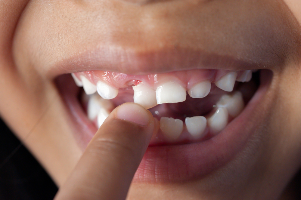 wiggling-teeth-do-i-need-to-worry-adelberg-montalvan-pediatric
