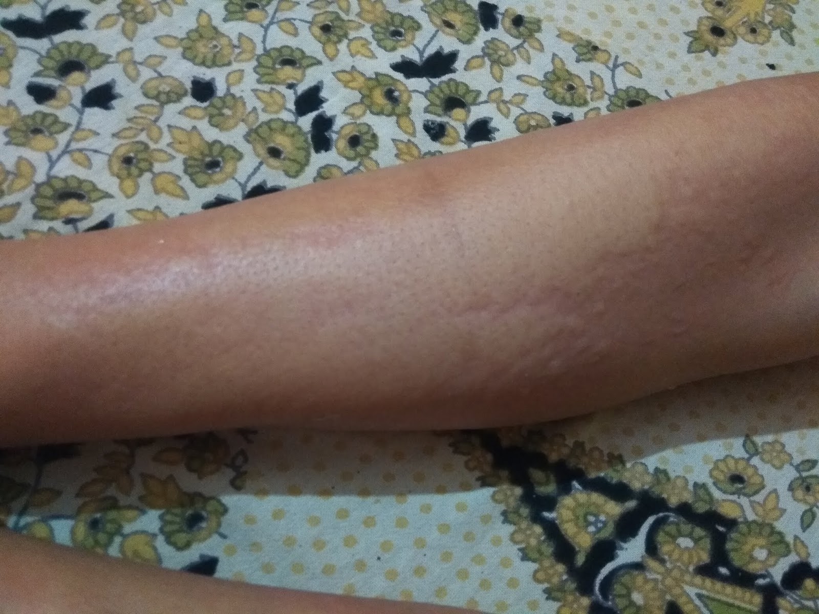 What is Hives or Urticaria or P itti Uchalna