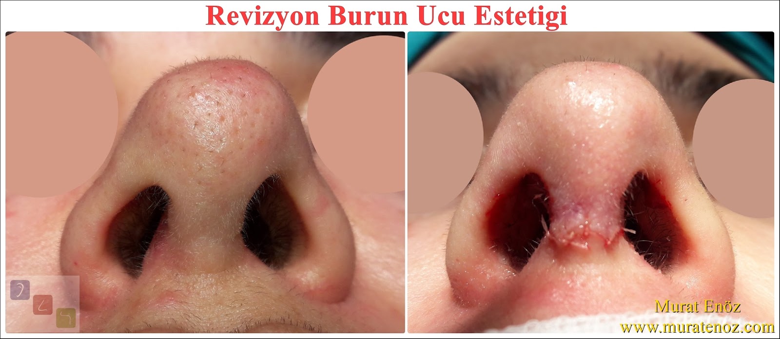 Burunda Revizyon Ameliyatı Nedir Burunda Revizyon Ameliyatı Nedir