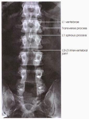 lumbar spine radiograph