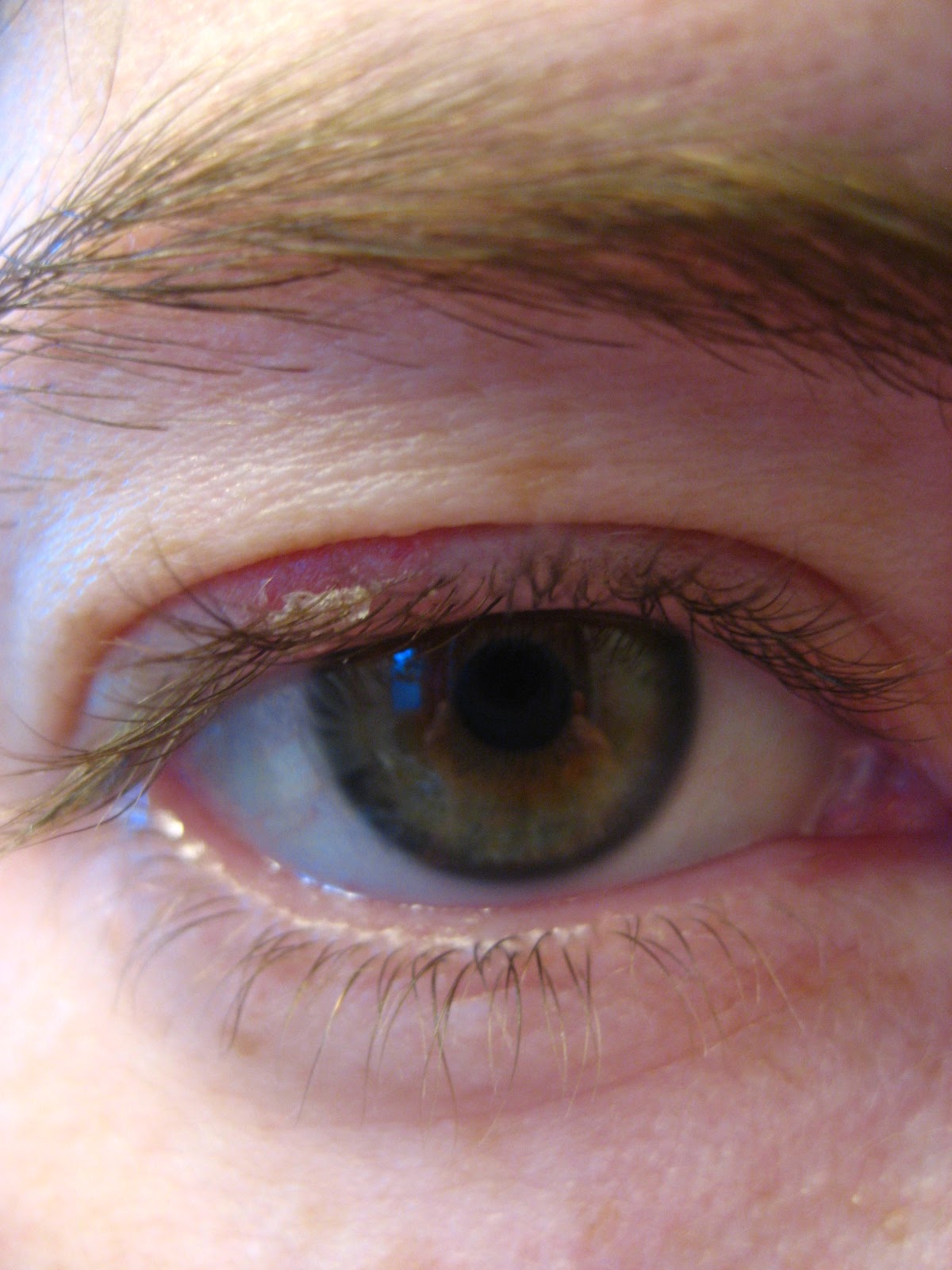 One Woman's Health Watch Sty