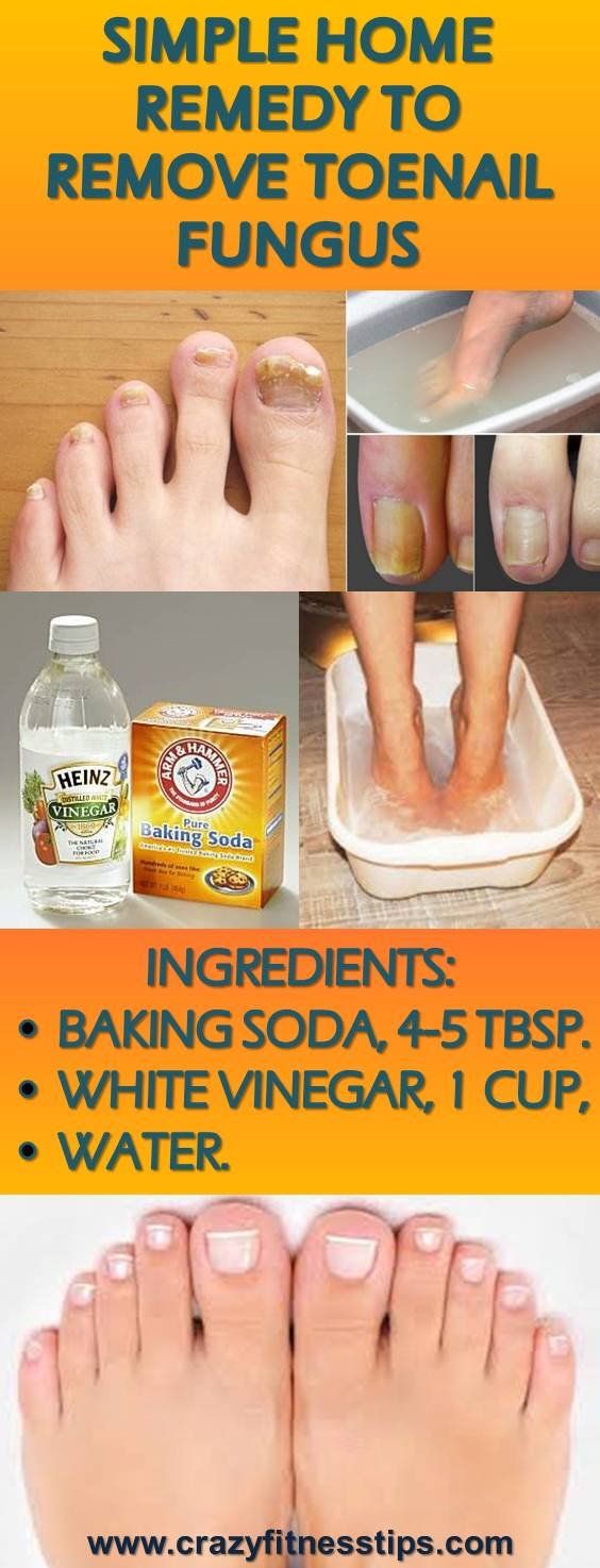 Simple Home Remedy To Remove Toenail Fungus Health Recipes