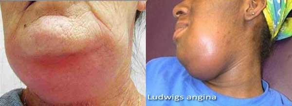 ludwig s angina