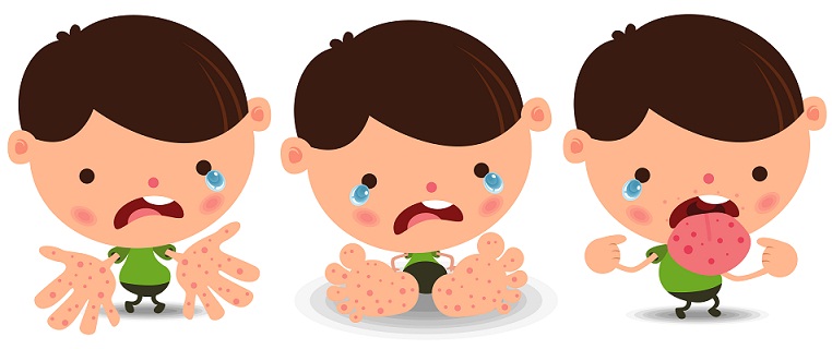 Cara Mengobati Flu Singapura Pada Anak Cara Mengobati Flu Singapura Pada Anak
