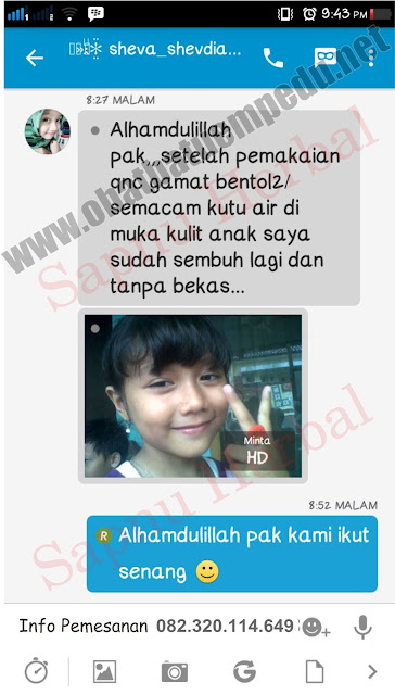 Cara Mengobati Kurap Kering Yang Melebar Dengan Cepat , TERBUKTI Ampuh!! Cara Mengobati Kurap Kering Yang Melebar Dengan Cepat , TERBUKTI Ampuh!!