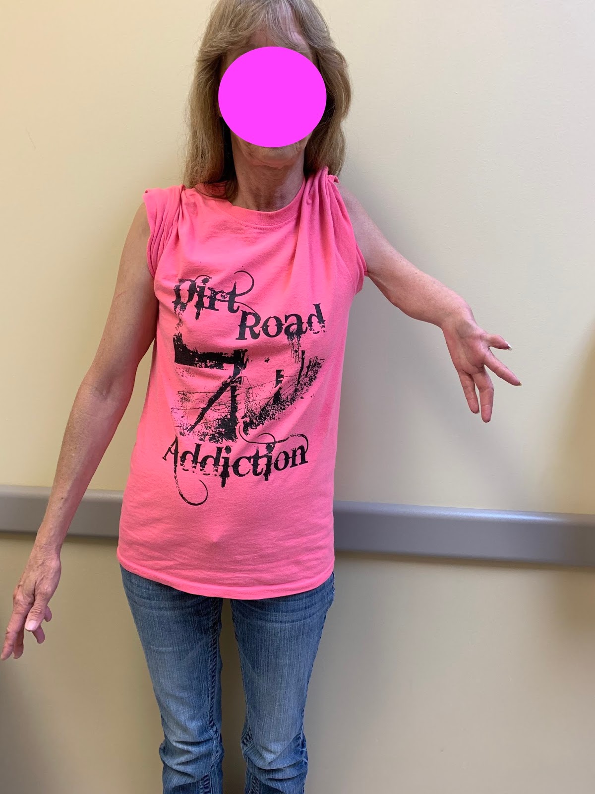 short-arm-and-hand-deficiency-phocomelia-or-longitudinal-deficiency