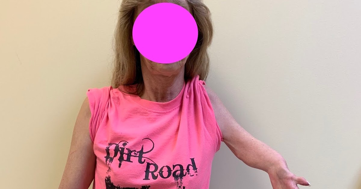 Short arm and hand deficiency or longitudinal deficiency