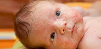 Gluten Alerjisi Nedir? Bebeklerde Gluten Alerjisi