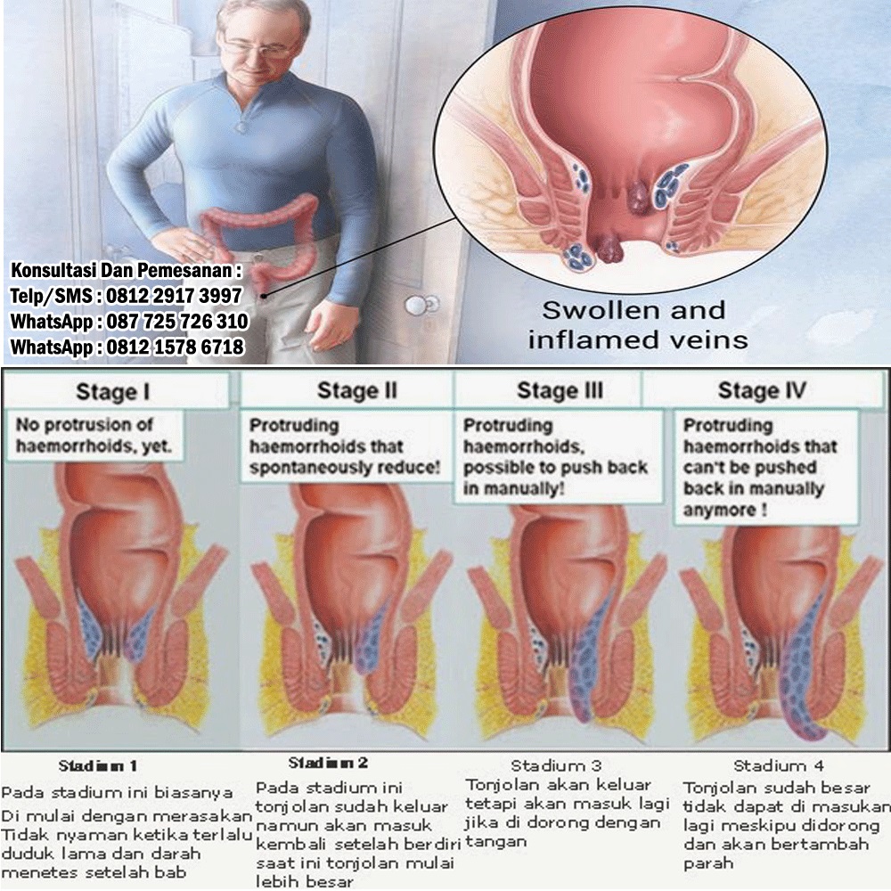 Hemoroid Wasir Berita Biologi