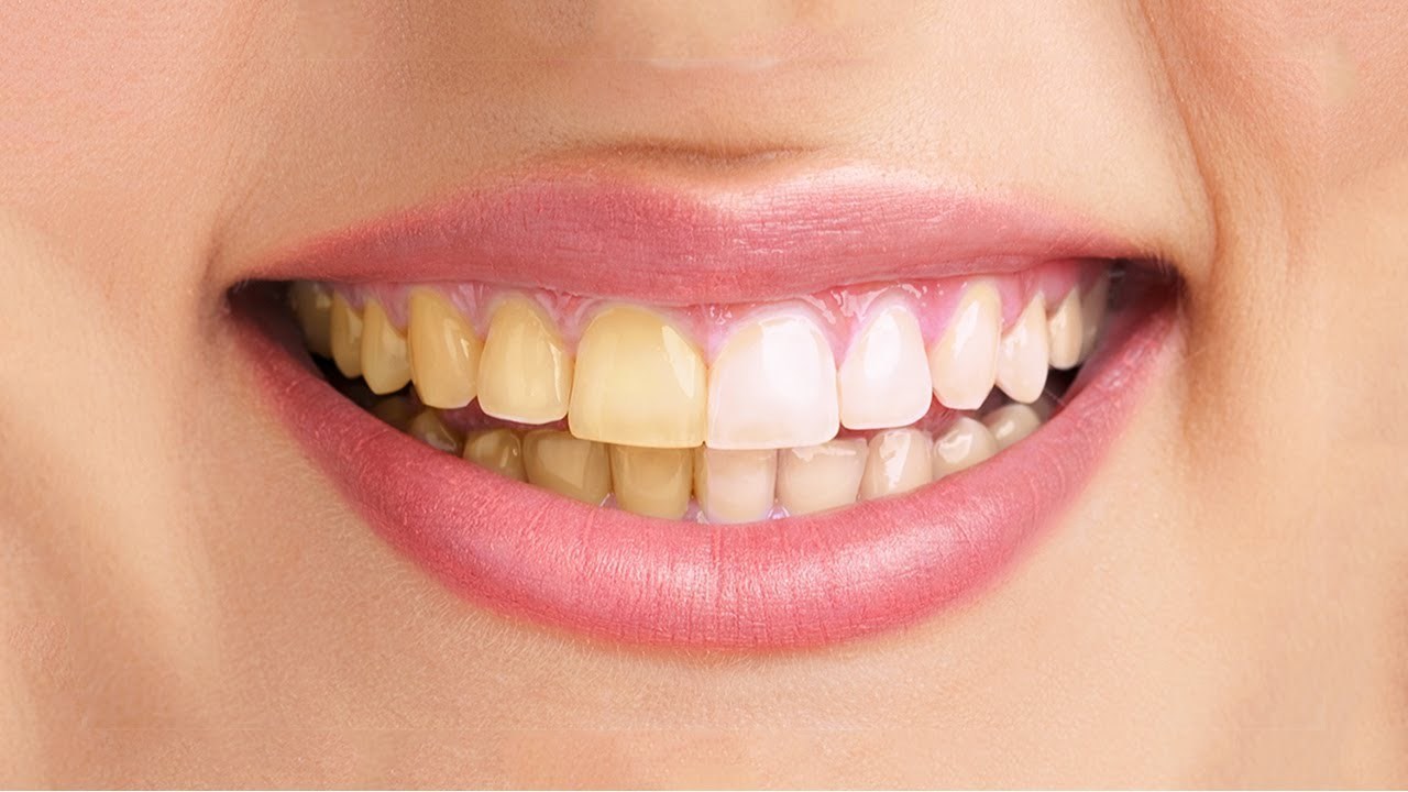 Do Yellow Stains On Teeth Go Away