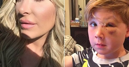 zolciak bit by zolciak shares photos of s injuries after he was bitten by a zolciak bit by zolciak shares photos of s injuries after he was bitten by a