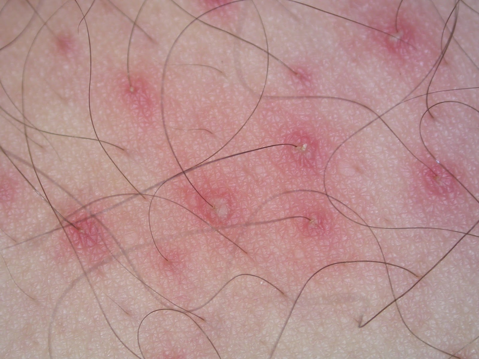 Streaming Handjob Video Folliculitis On The Penis