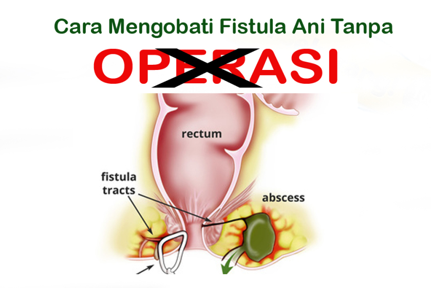 jelly gamat untuk fistula ani jelly gamat qnc asli jelly gamat untuk fistula ani jelly gamat qnc asli