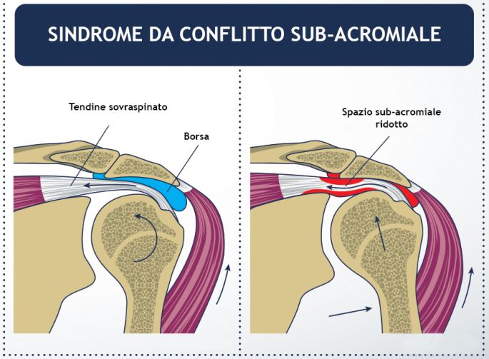 Osteopata Milano Osteopata Segrate LESIONE DELLA CUFFIA DEI ROTATORI ED OSTEOPATIA Osteopata Milano Osteopata Segrate LESIONE DELLA CUFFIA DEI ROTATORI ED OSTEOPATIA