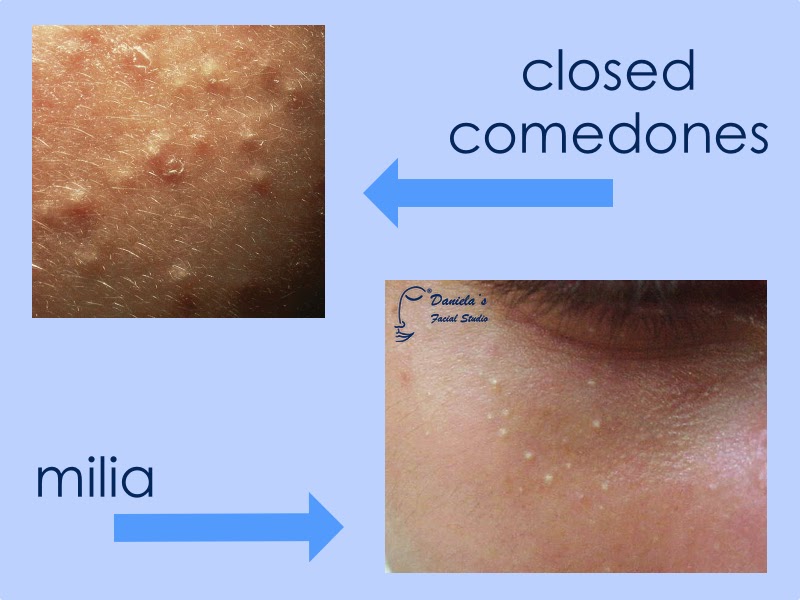 Comedones - Dermatologist