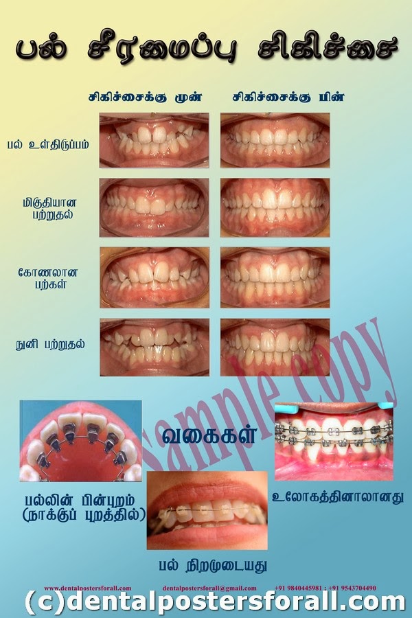 Dental Posters to Educate Patients January 2014