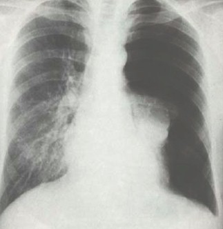 barotrauma ventilator barotrauma ventilator