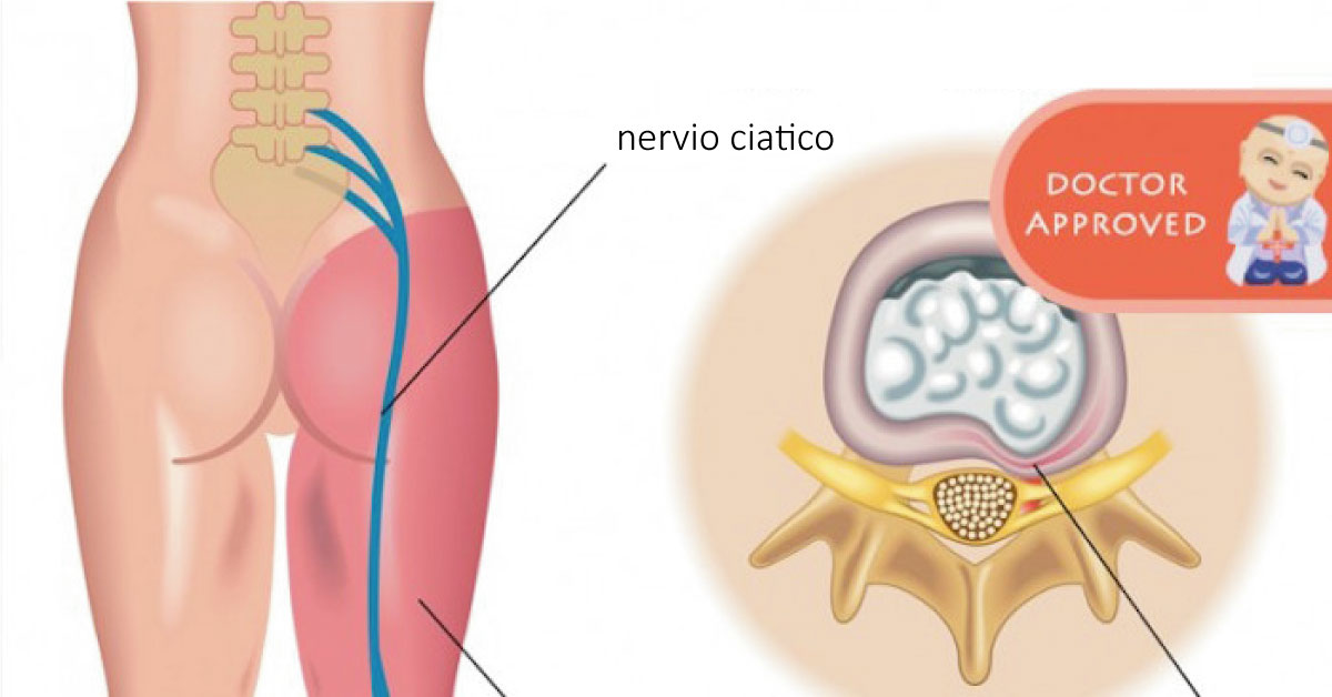 La hernia de la columna vertebral de la causa y los modos del tratamiento